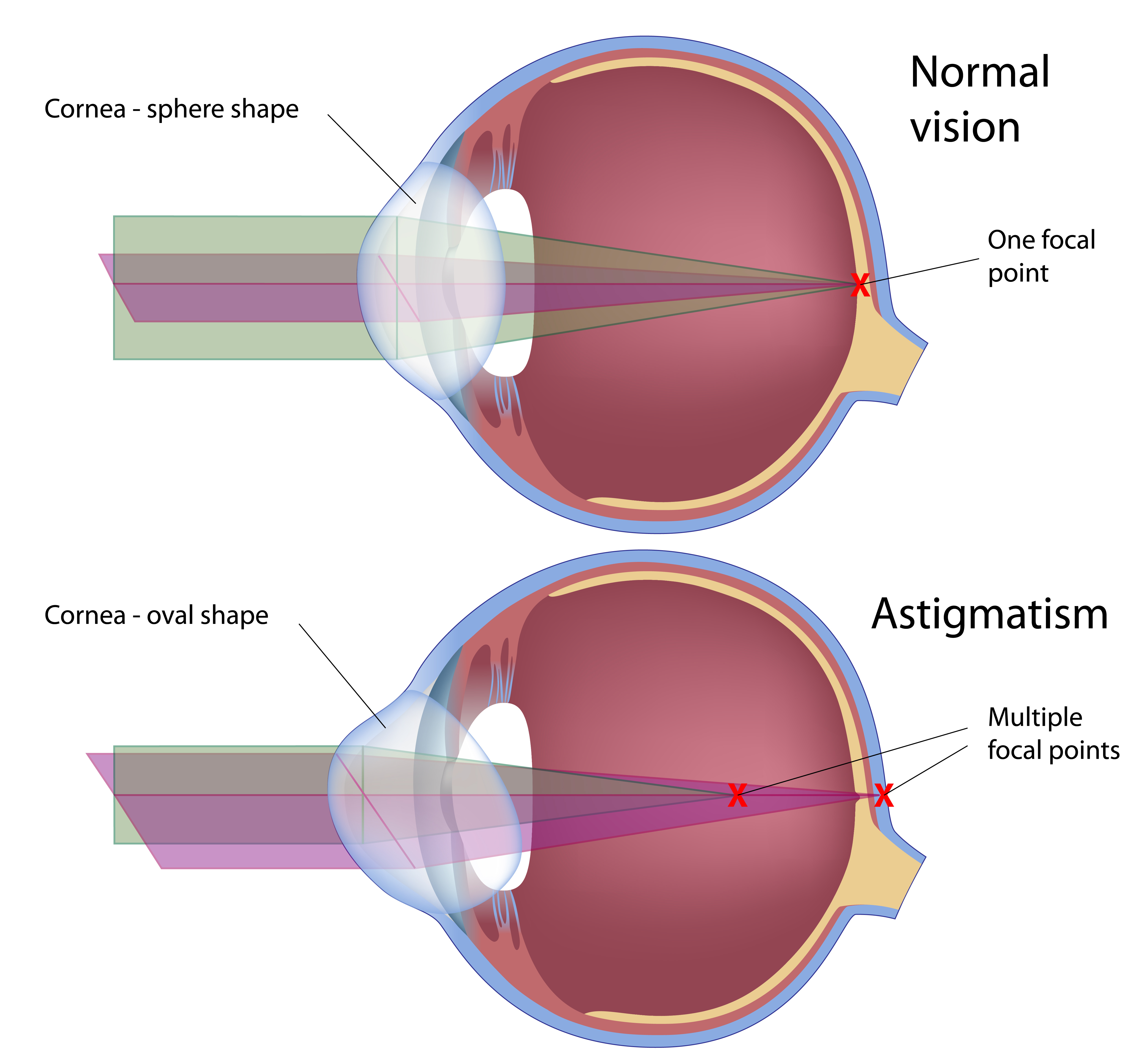 Astigmatism Eye Structure Diagram
